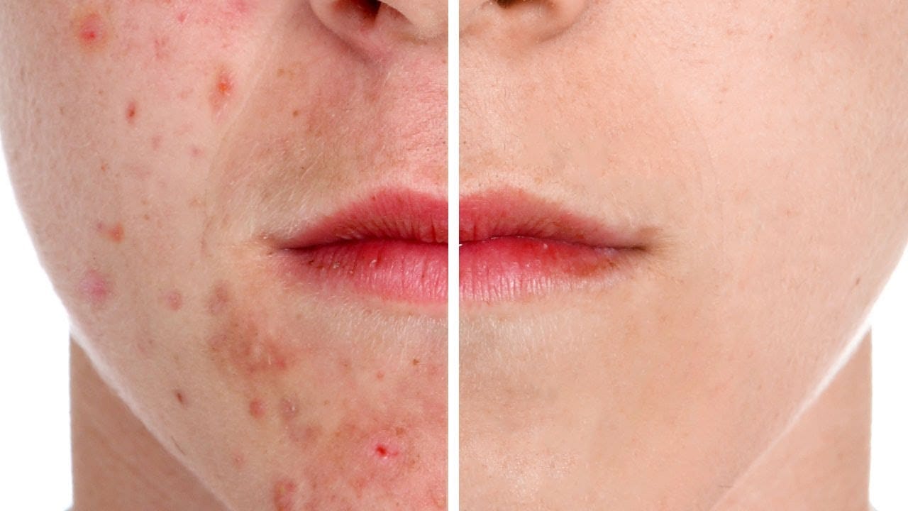 How to Remove Acne in Photoshop